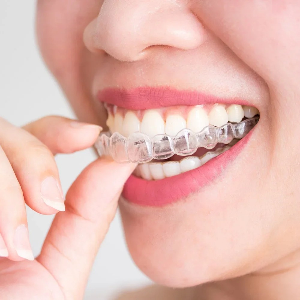 Dental Guard Night - 1-4 Stuks Anti-Snorkel- en Bruxisme-Mondbeschermer, Slaapbeschermer,