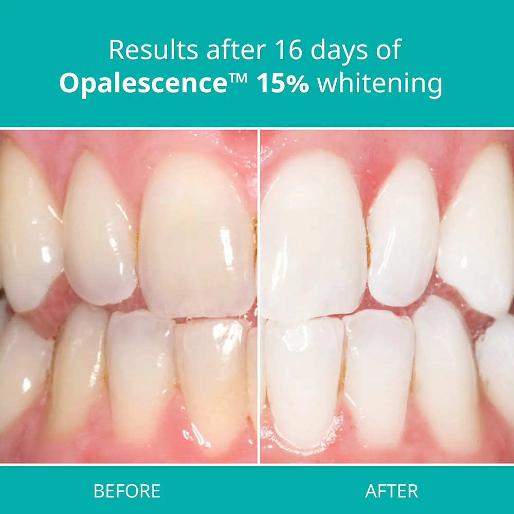 Opalescence Professionele Whit - Teeth Whitening Gel Refills recensie en prijs
