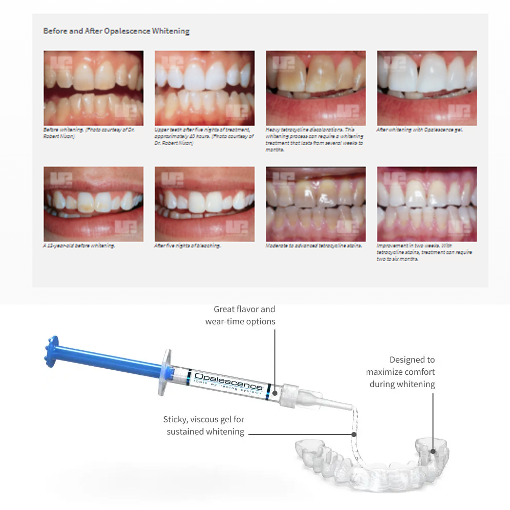 Opalescentie Whitening 20% Pf  - Teeth Whitening At Home Kit recensie en prijs