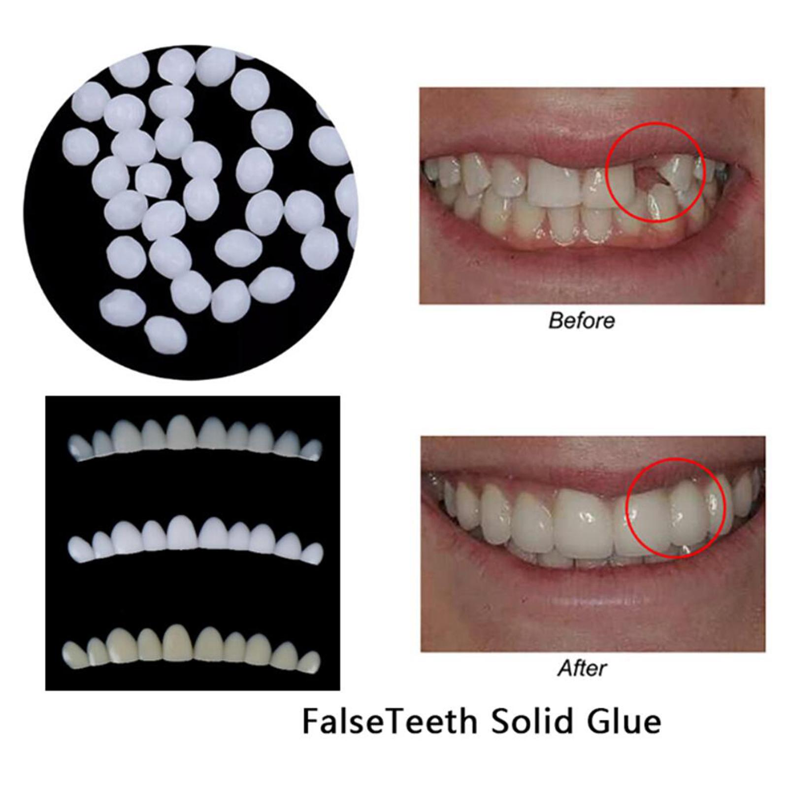 Tijdelijke tandenbleekset met  - Teeth Whitening At Home Kit recensie en prijs