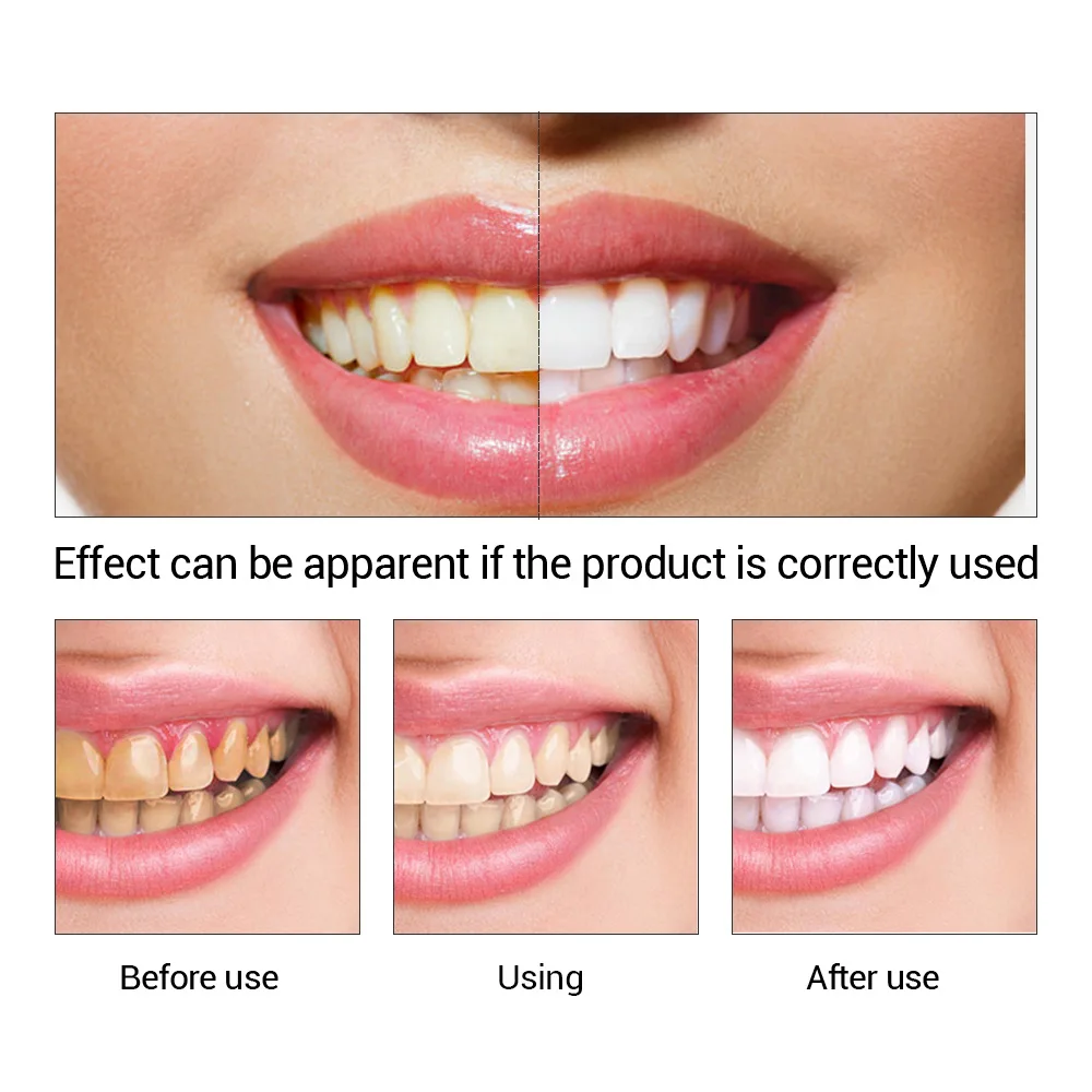 Fteenply Tanden Whitening Esse - Teeth Whitening Co recensie en prijs